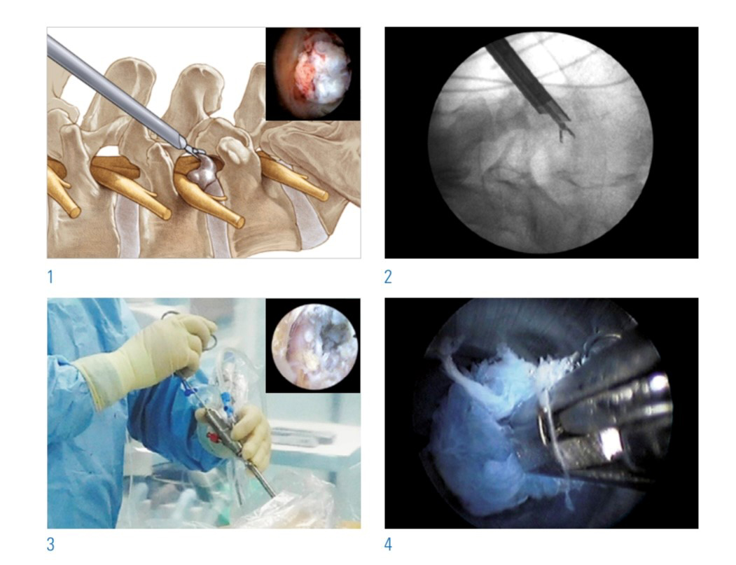 Endoskopische Bandcheibenchirurgie